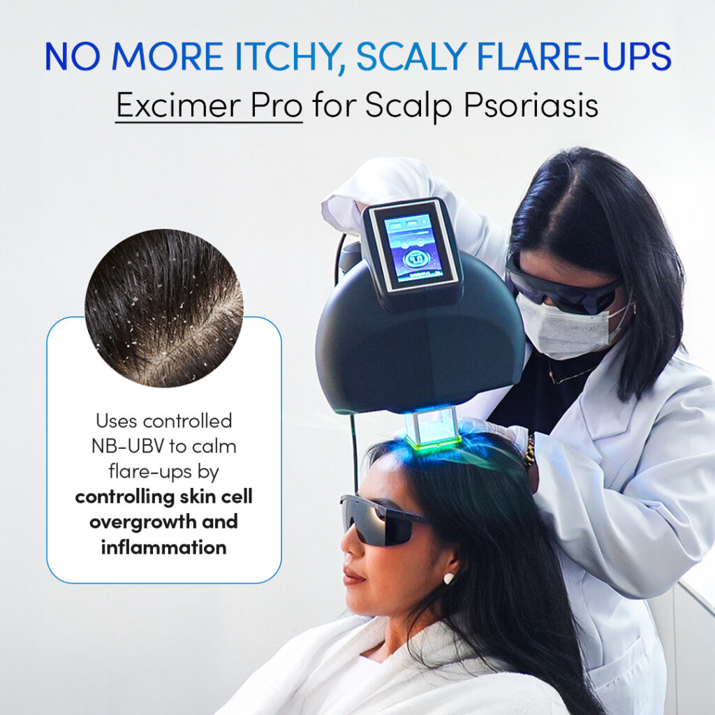 The Best Scalp Psoriasis Treatment in the Philippines 2 FILL IT EXCIMERPRO SCAP PSORIASIS 02192025 V2
