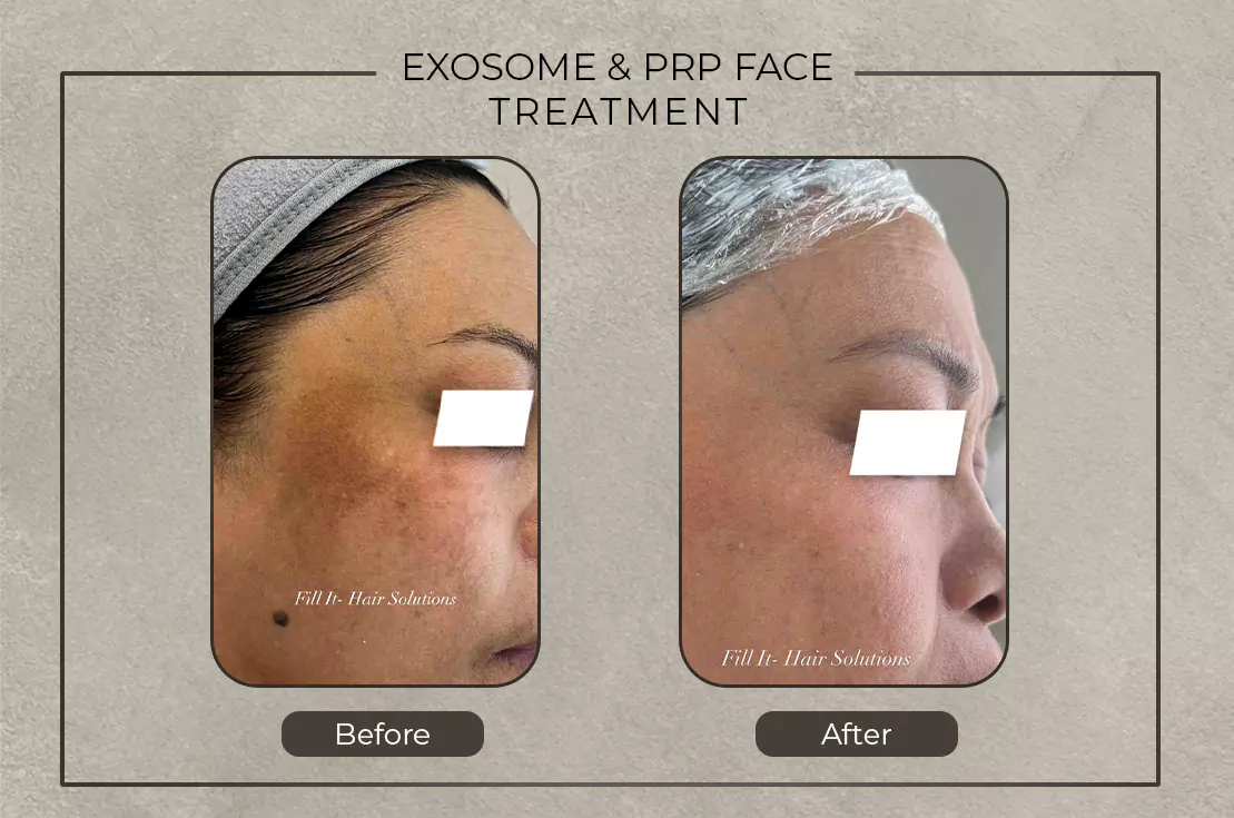fill it before and after exosome and prp face treatment 679b1a40568c0