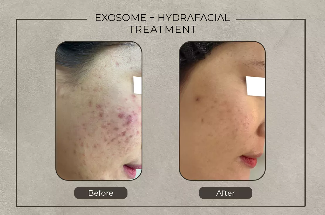 fill it before and after exosome hydrafacial treatment 679b2324ba752