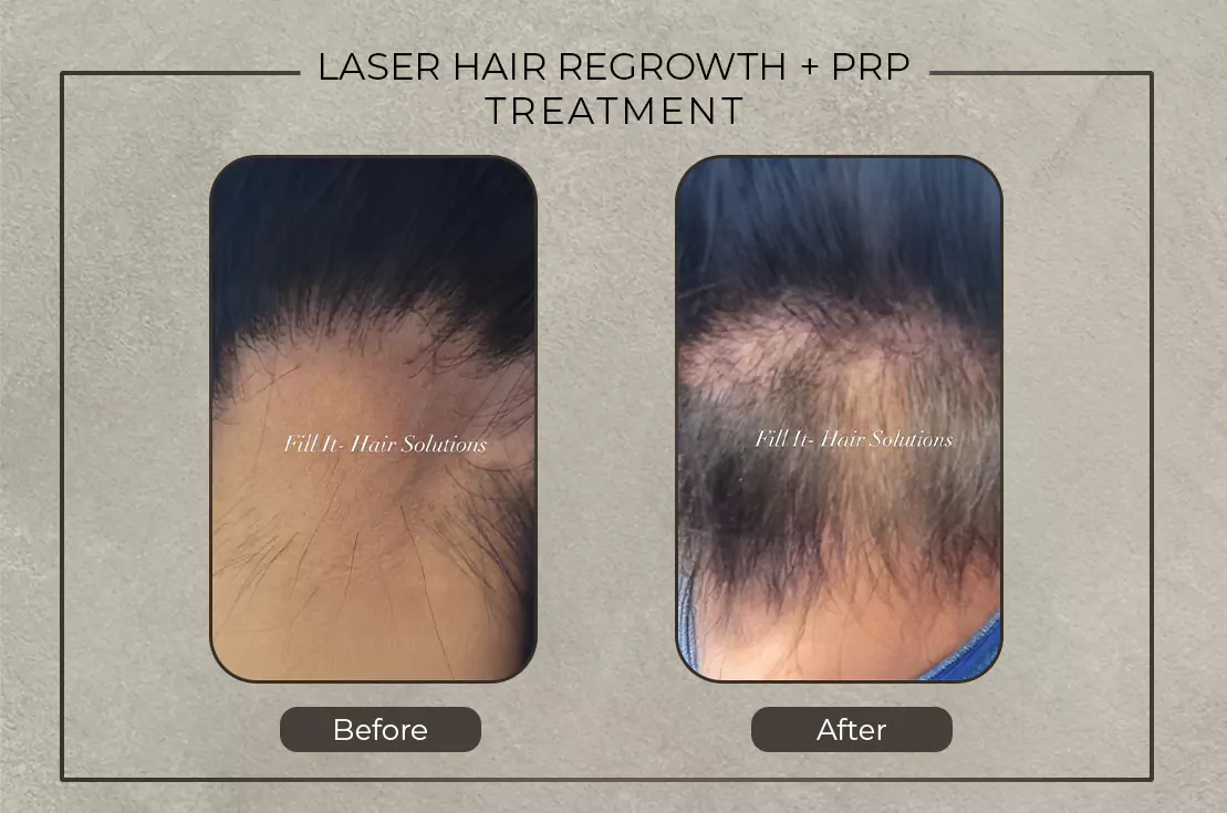 fill it before and after laser hair regrowth prp treatment 679b225bd9204
