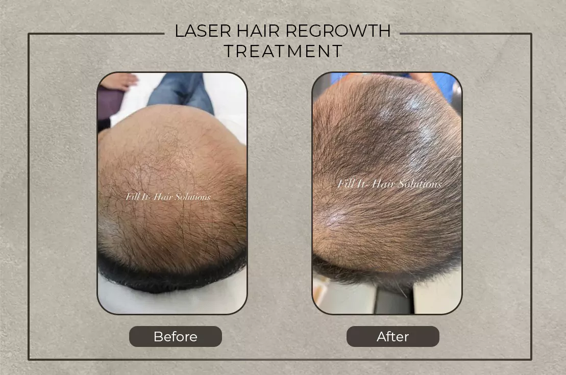 fill it before and after laser hair regrowth treatment 679b240435626